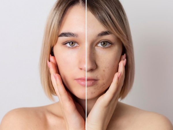 Anti-acne: Conheça os produtos e remédios mais indicados