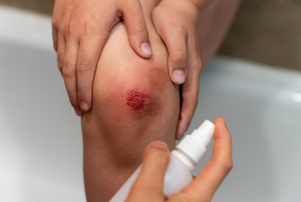 Quais são os remédios eficazes para cicatrizar feridas profundas?